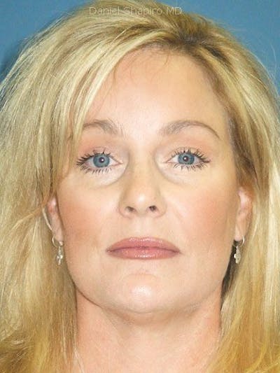 Brow Lift Before & After Gallery - Patient 17344111 - Image 2
