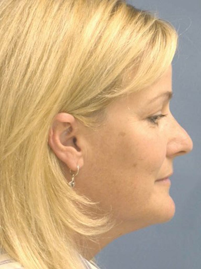 Brow Lift Before & After Gallery - Patient 17344111 - Image 3