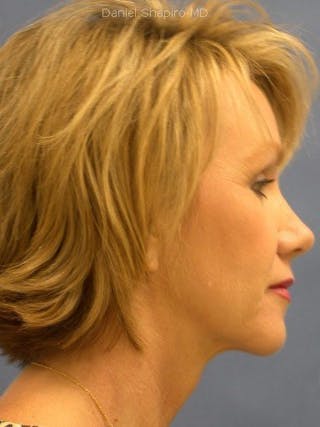 Brow Lift Before & After Gallery - Patient 17344113 - Image 4