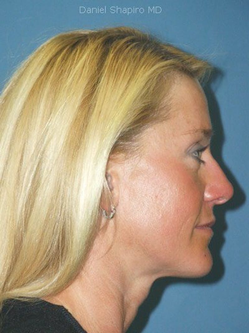 Brow Lift Before & After Gallery - Patient 17344115 - Image 4