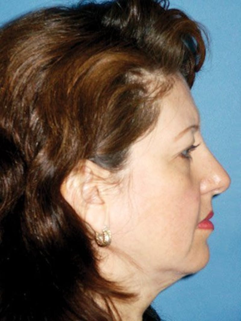 Brow Lift Before & After Gallery - Patient 17344117 - Image 3