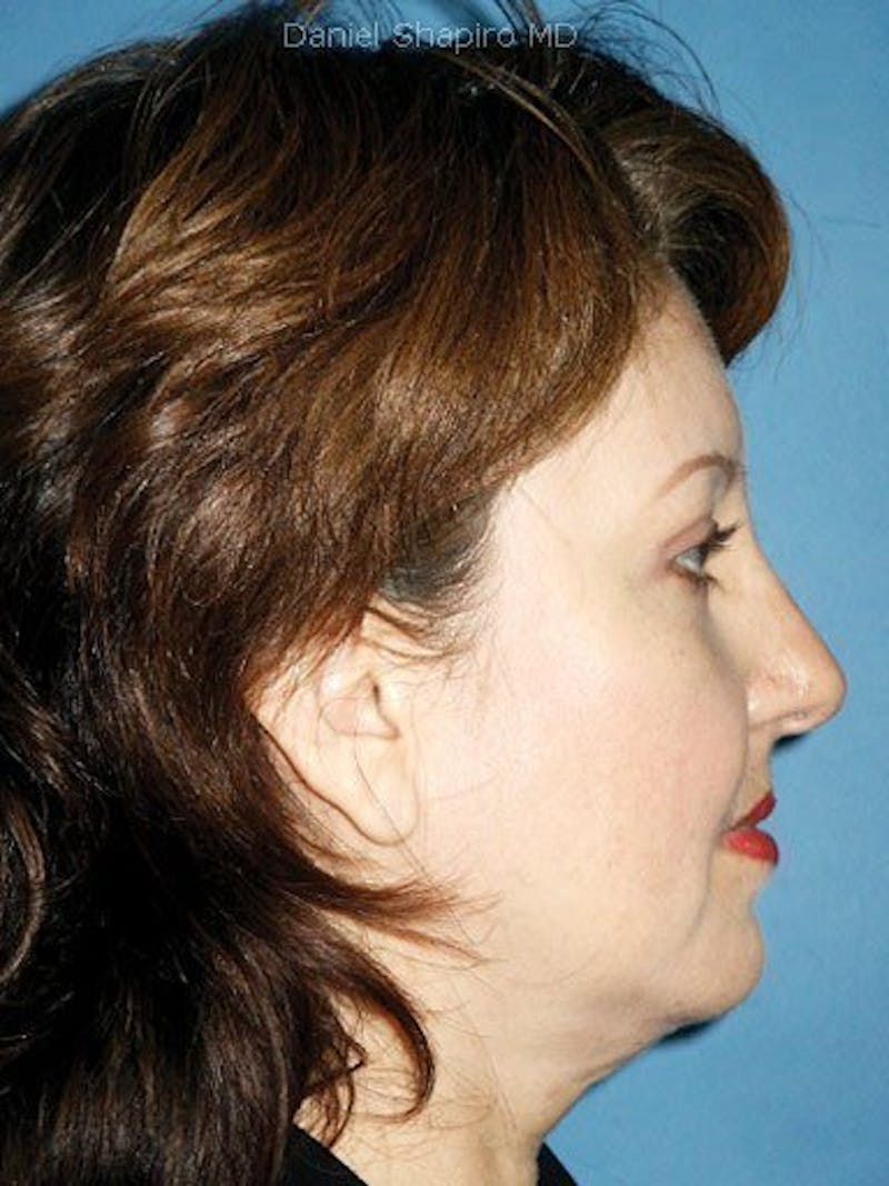 Brow Lift Before & After Gallery - Patient 17344117 - Image 4