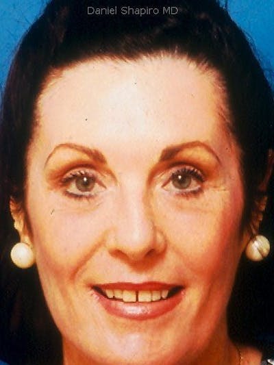 Brow Lift Before & After Gallery - Patient 17344119 - Image 2