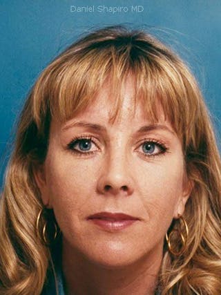 Brow Lift Before & After Gallery - Patient 17344125 - Image 2