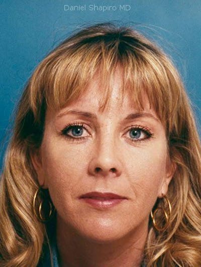 Brow Lift Before & After Gallery - Patient 17344125 - Image 2
