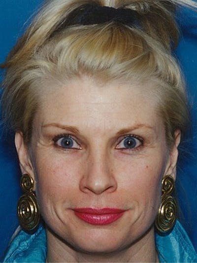 Brow Lift Before & After Gallery - Patient 17344127 - Image 1