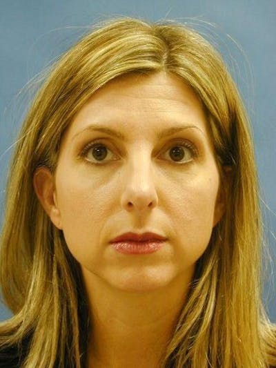 Brow Lift Before & After Gallery - Patient 17344129 - Image 1