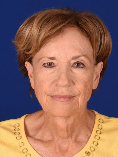 Eyes Before & After Gallery - Patient 17362947 - Image 1