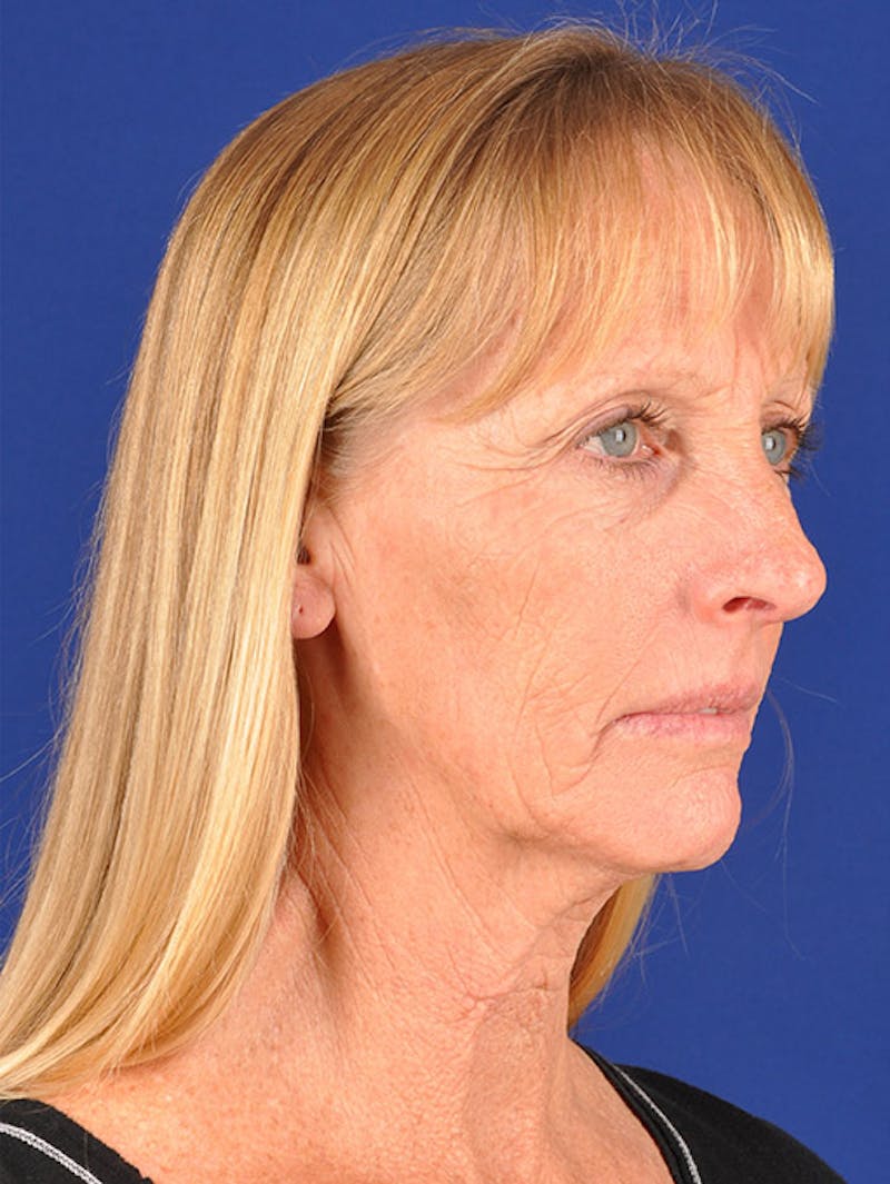 Fat Transfer Face Before & After Gallery - Patient 17362941 - Image 3