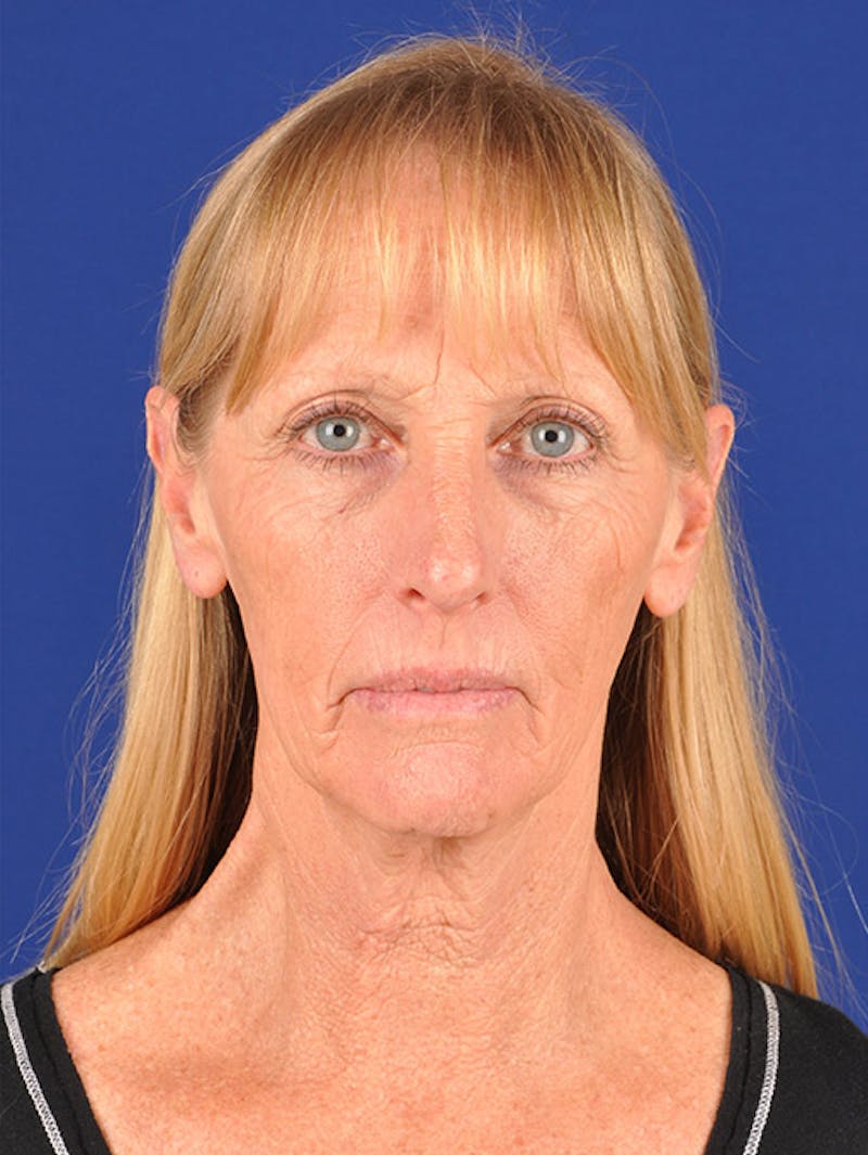 Laser Resurfacing Before & After Gallery - Patient 17362945 - Image 1