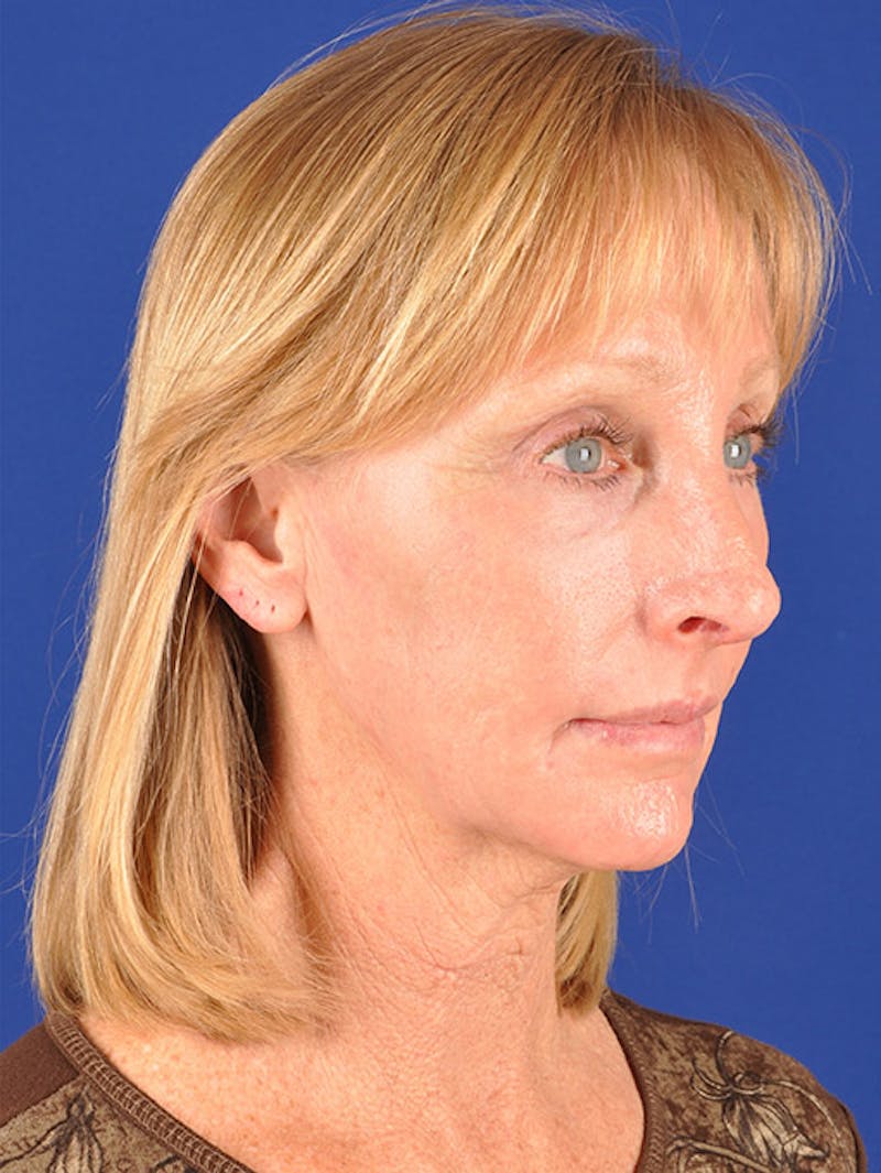 Laser Resurfacing Before & After Gallery - Patient 17362945 - Image 4