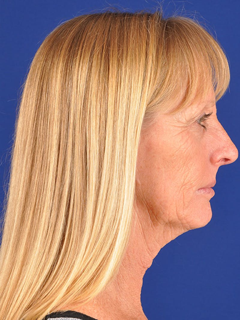 Laser Resurfacing Before & After Gallery - Patient 17362945 - Image 5