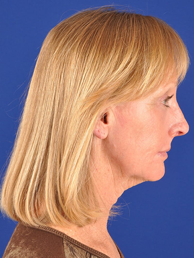 Laser Resurfacing Before & After Gallery - Patient 17362945 - Image 6