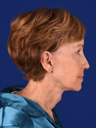 Eyes Before & After Gallery - Patient 17362947 - Image 6