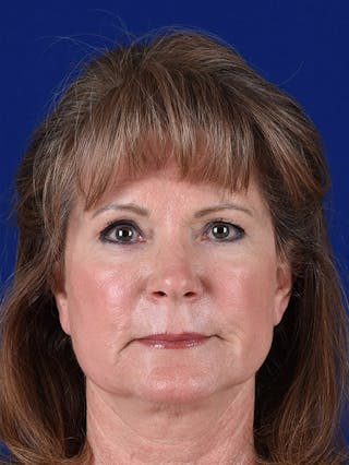 Laser Resurfacing Before & After Gallery - Patient 17362949 - Image 2
