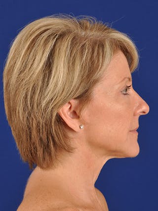 Fat Transfer Face Before & After Gallery - Patient 17362948 - Image 6