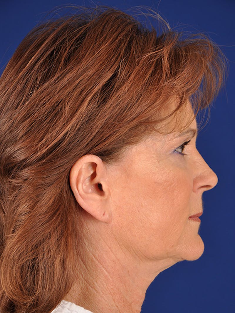 Laser Resurfacing Before & After Gallery - Patient 17362949 - Image 5