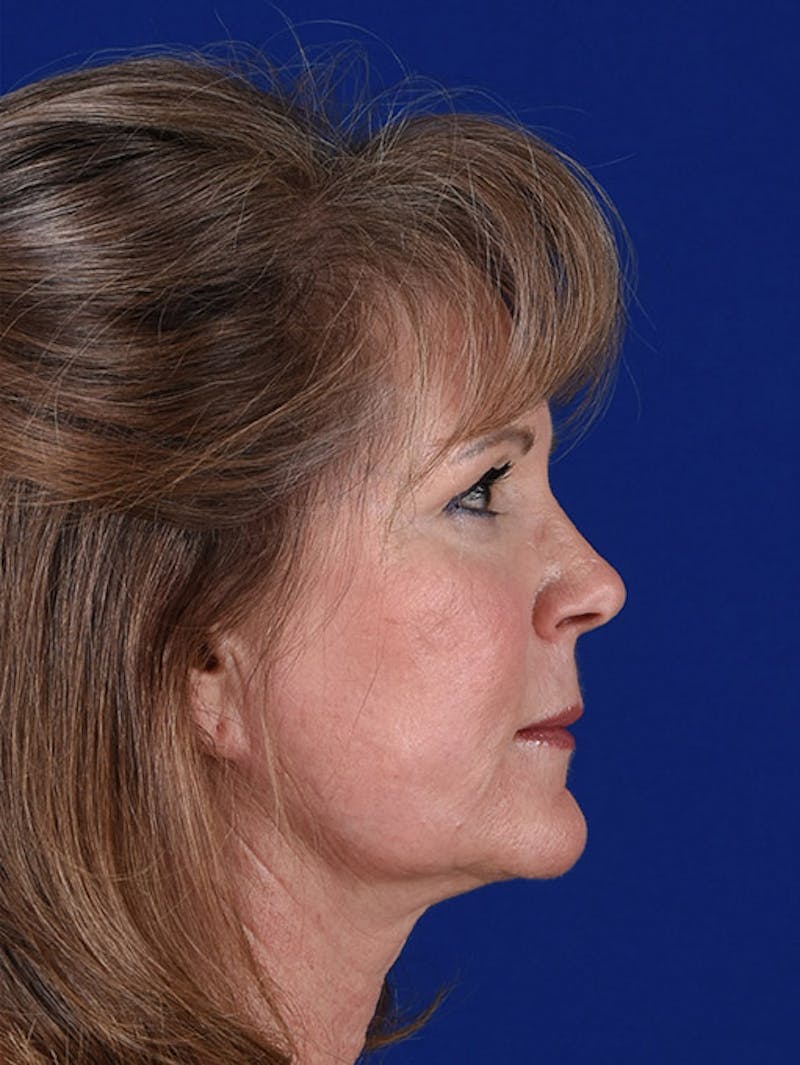 Laser Resurfacing Before & After Gallery - Patient 17362949 - Image 6