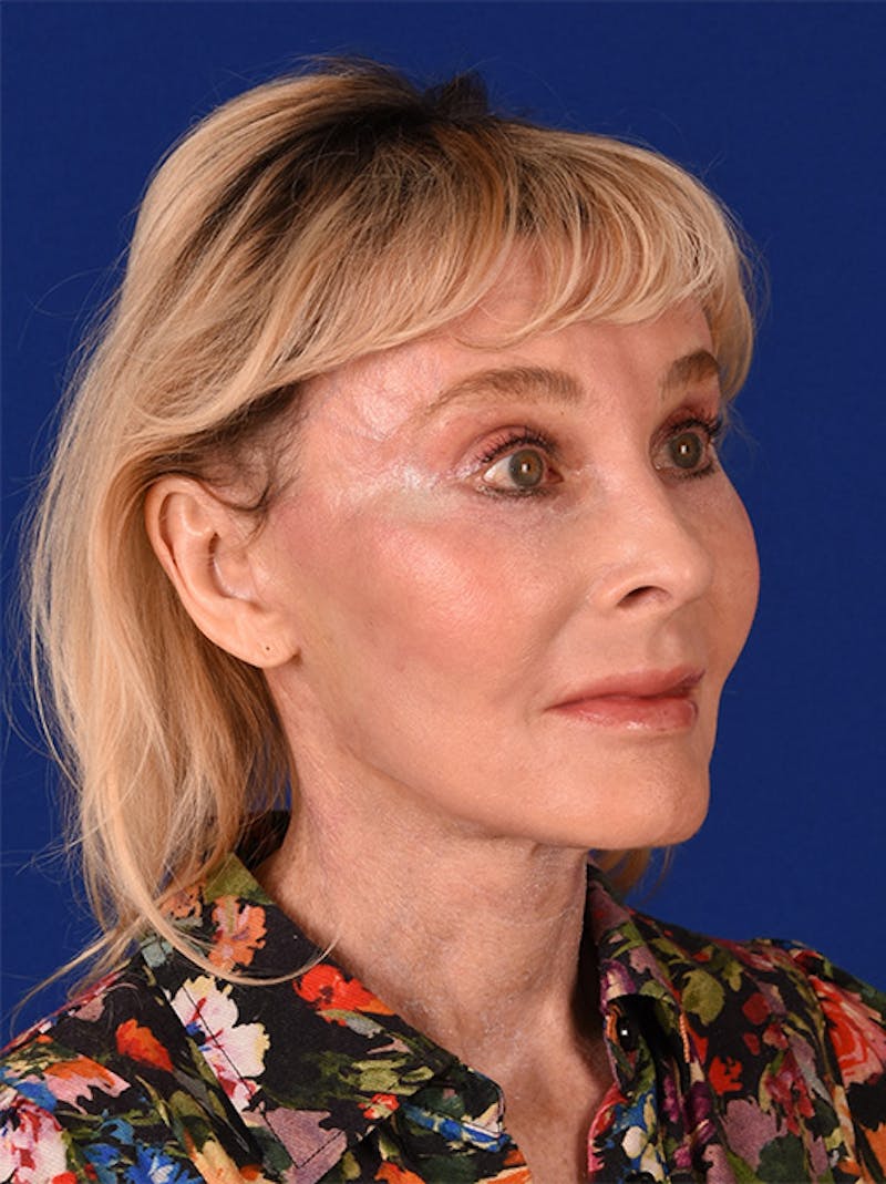 Laser Resurfacing Before & After Gallery - Patient 17362952 - Image 4