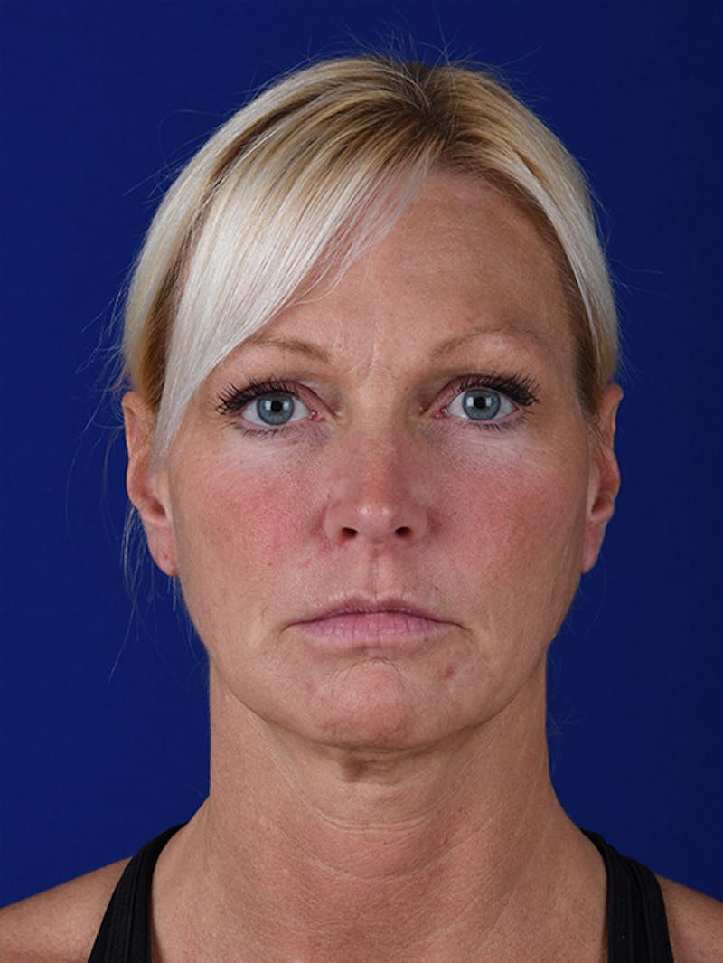 Laser Resurfacing Before & After Gallery - Patient 17362956 - Image 1