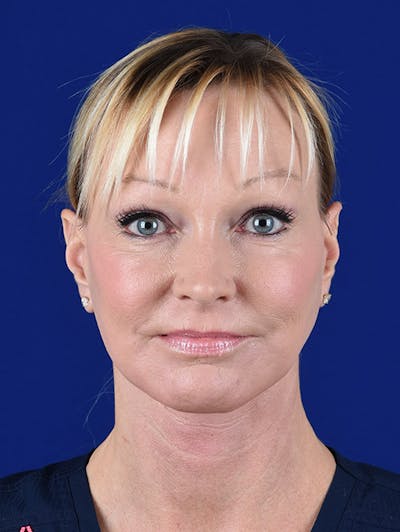 Laser Resurfacing Before & After Gallery - Patient 17362956 - Image 2