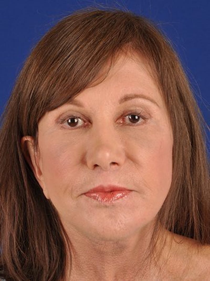 Fat Transfer Face Before & After Gallery - Patient 17362955 - Image 2