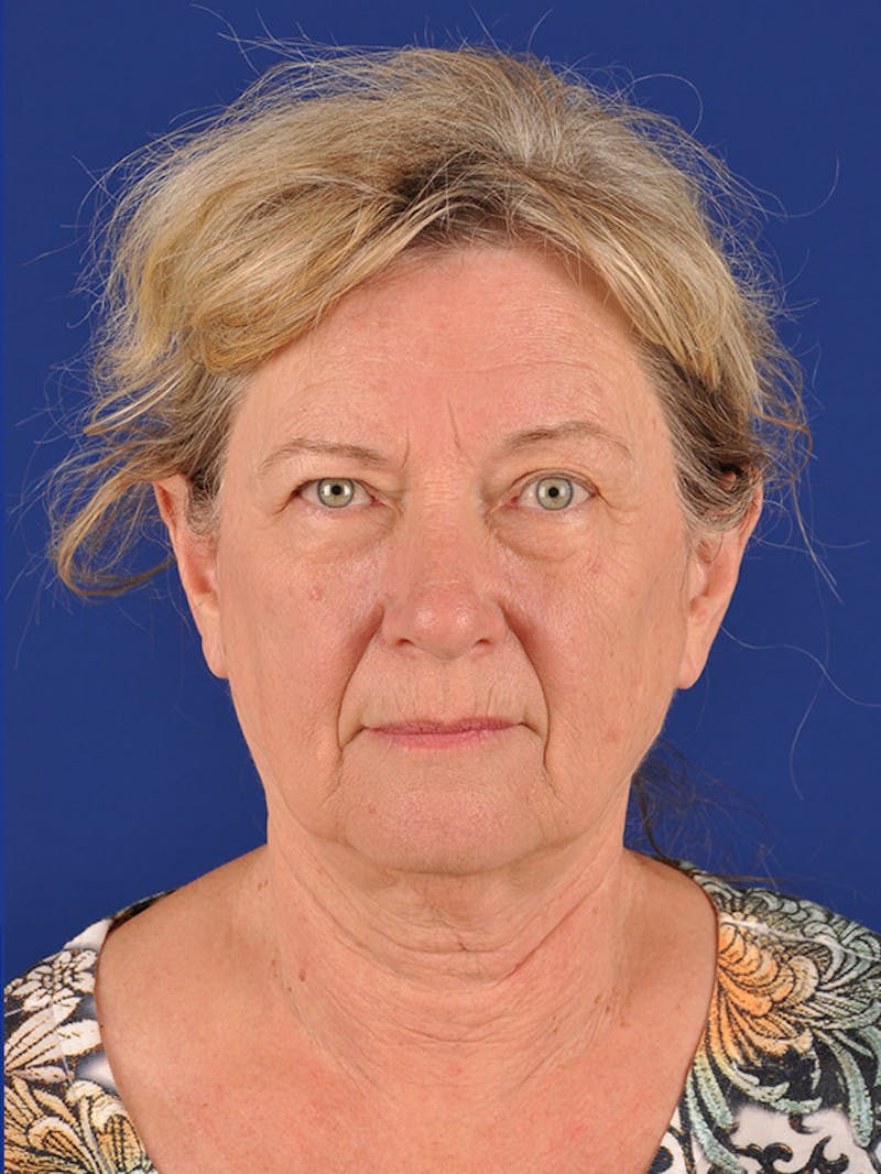 Eyes Before & After Gallery - Patient 17362958 - Image 1