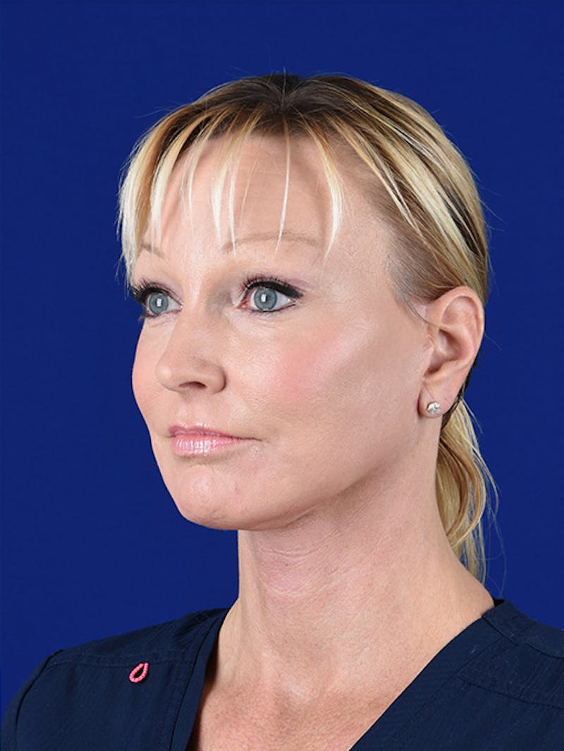 Laser Resurfacing Before & After Gallery - Patient 17362956 - Image 4