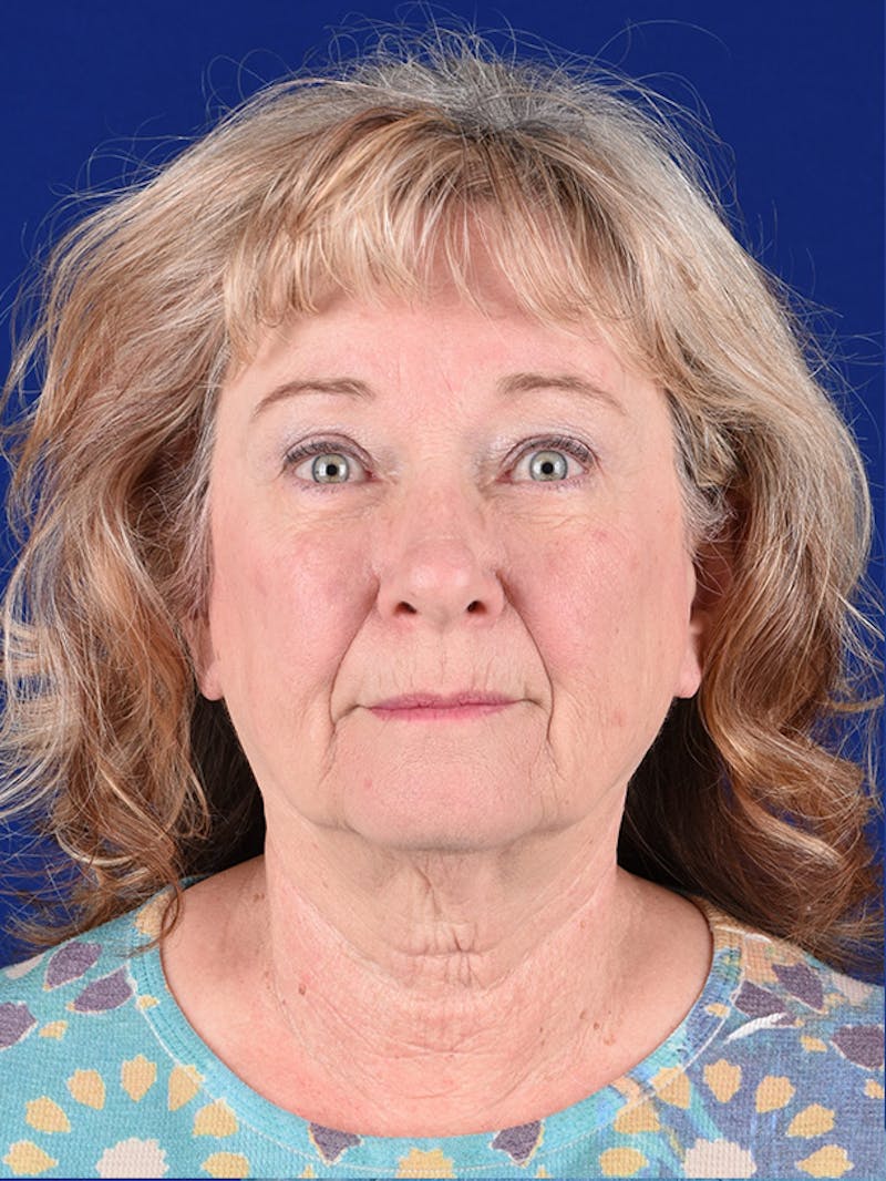 Eyes Before & After Gallery - Patient 17362958 - Image 2