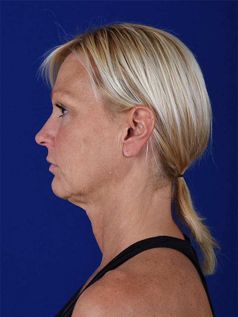 Laser Resurfacing Before & After Gallery - Patient 17362956 - Image 5