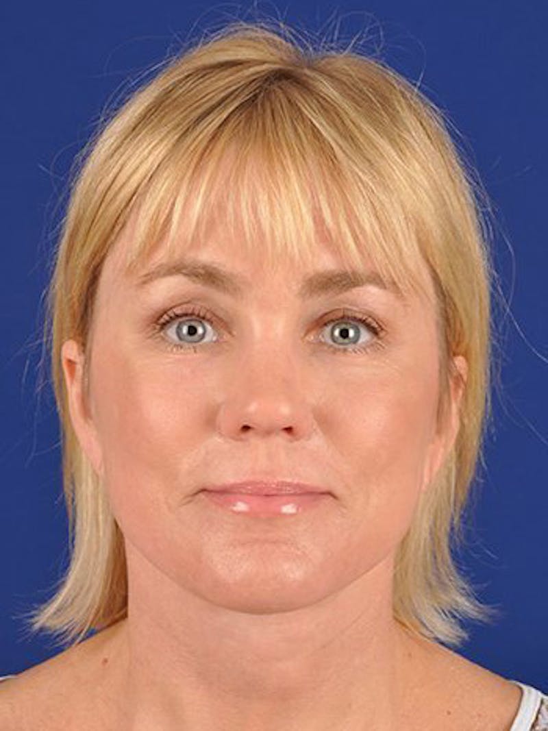 Fat Transfer Face Before & After Gallery - Patient 17362960 - Image 2