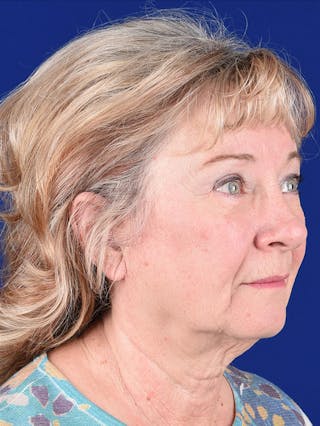 Eyes Before & After Gallery - Patient 17362958 - Image 4