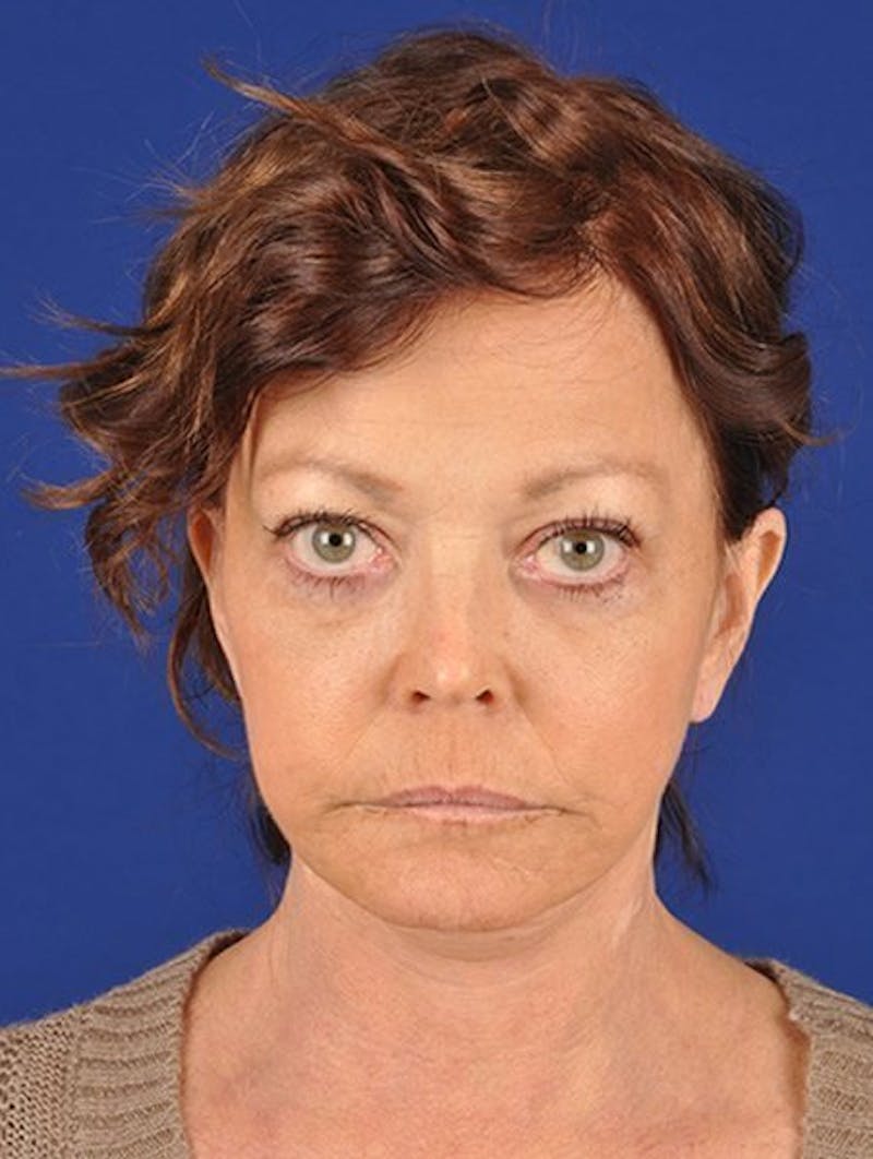 Laser Resurfacing Before & After Gallery - Patient 17362959 - Image 1