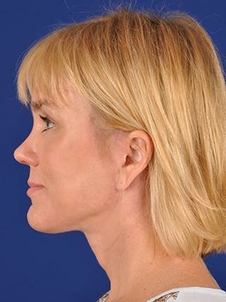 Fat Transfer Face Before & After Gallery - Patient 17362960 - Image 6