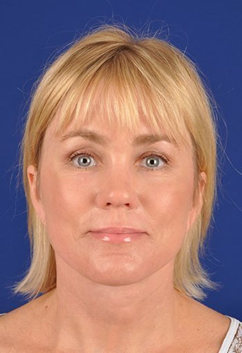 Laser Resurfacing Before & After Gallery - Patient 17362961 - Image 2