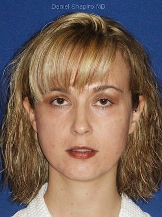 Laser Resurfacing Before & After Gallery - Patient 17362965 - Image 2