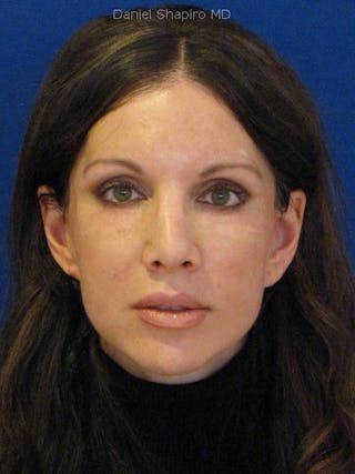 Fat Transfer Face Before & After Gallery - Patient 17362967 - Image 2