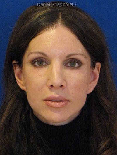 Fat Transfer Face Before & After Gallery - Patient 17362967 - Image 2
