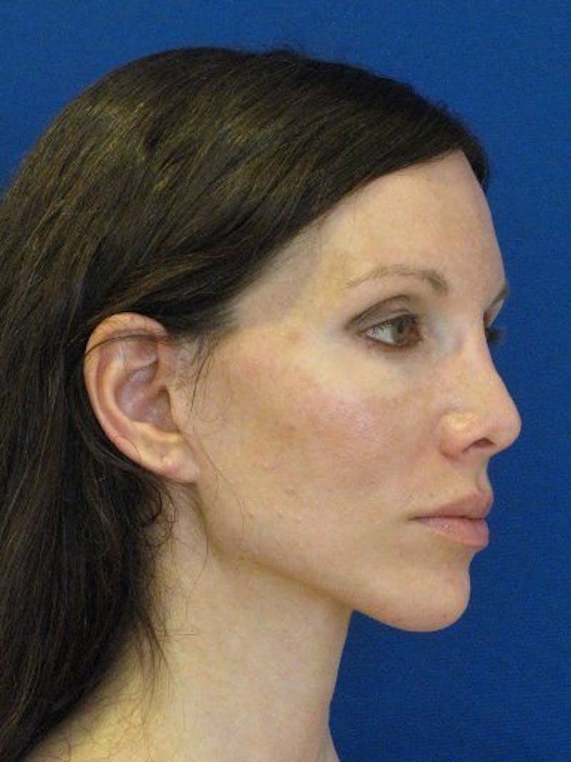 Fat Transfer Face Before & After Gallery - Patient 17362967 - Image 3