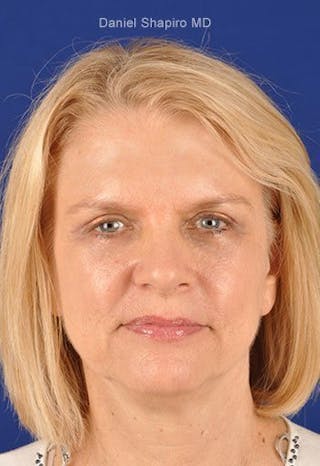 Eyes Before & After Gallery - Patient 17363006 - Image 2