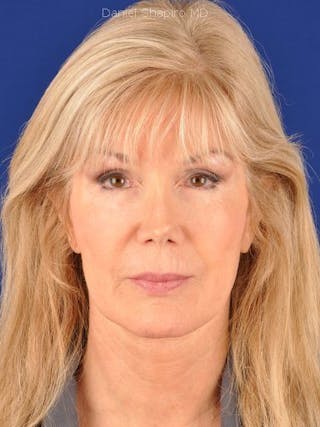 Fat Transfer Face Before & After Gallery - Patient 17363004 - Image 2