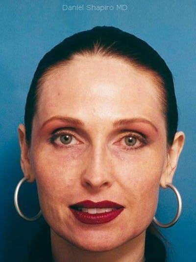 Laser Resurfacing Before & After Gallery - Patient 17363005 - Image 2