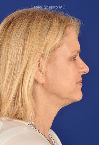 Eyes Before & After Gallery - Patient 17363006 - Image 6