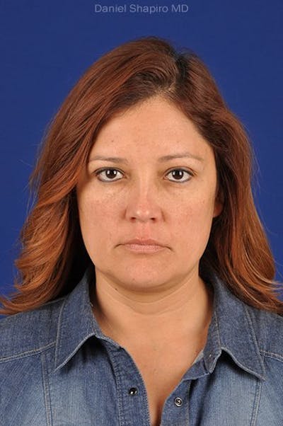 Eyes Before & After Gallery - Patient 17363009 - Image 1