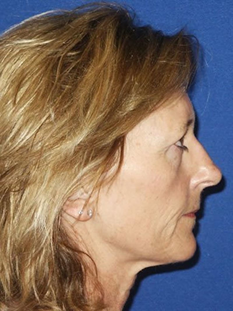 Laser Resurfacing Before & After Gallery - Patient 17363008 - Image 3