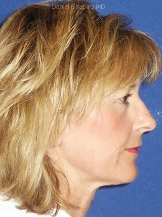 Laser Resurfacing Before & After Gallery - Patient 17363008 - Image 4