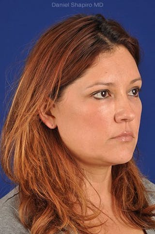 Eyes Before & After Gallery - Patient 17363009 - Image 4