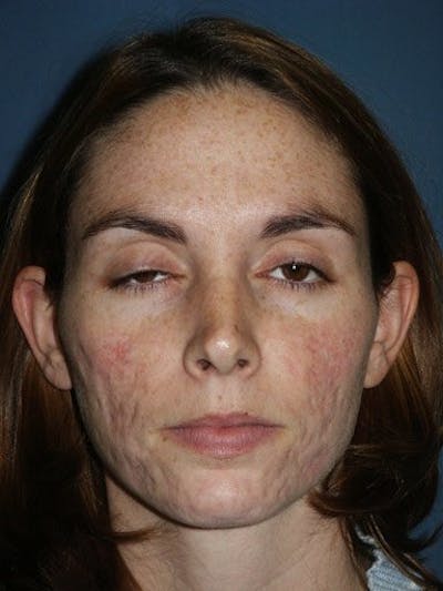 Laser Resurfacing Before & After Gallery - Patient 17363011 - Image 1