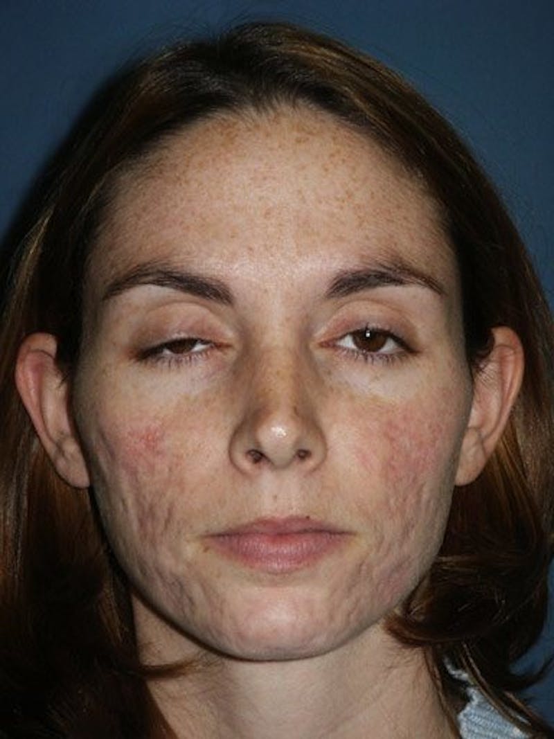 Laser Resurfacing Before & After Gallery - Patient 17363011 - Image 1