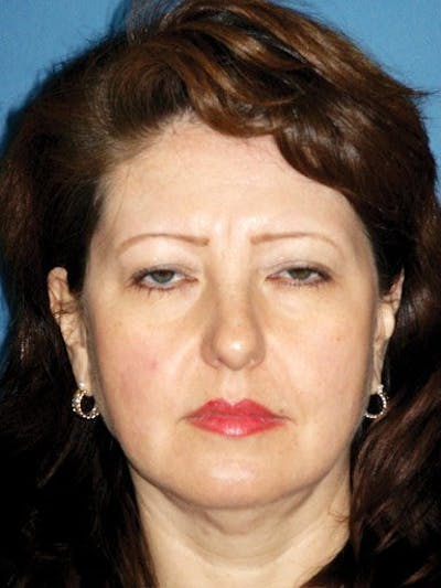 Eyes Before & After Gallery - Patient 17363012 - Image 1